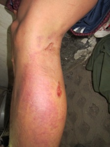 Stle Lin Shwe's bruised leg after the accident.